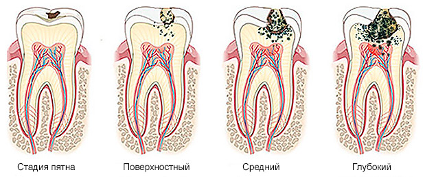 виды кариеса зубов