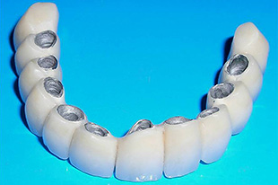 металлокерамические зубные коронки
