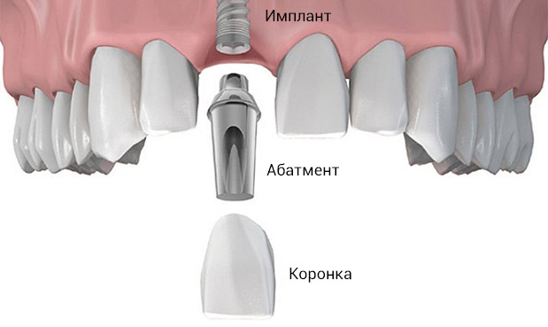 традиционная имплантация зубов
