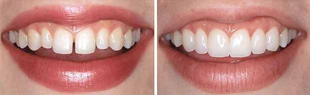 виниры на зубы пример до и после
