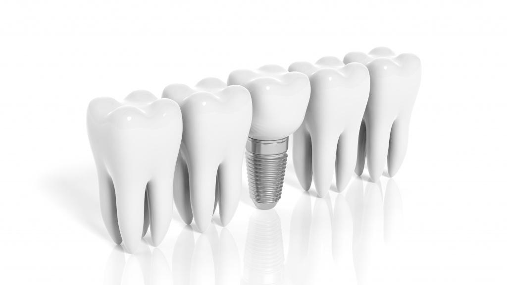 row-of-teeth-and-dental-implant-isolated-on-white-background.jpg
