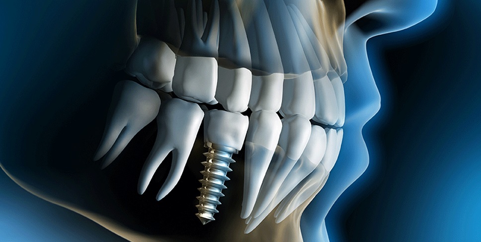Dental-Implants2.jpg